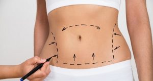 recuperación liposucción