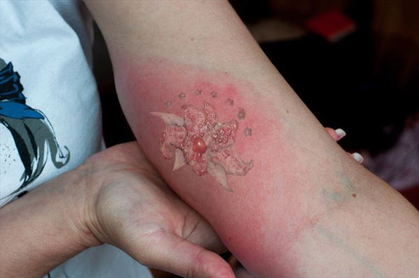 tattoo infectado